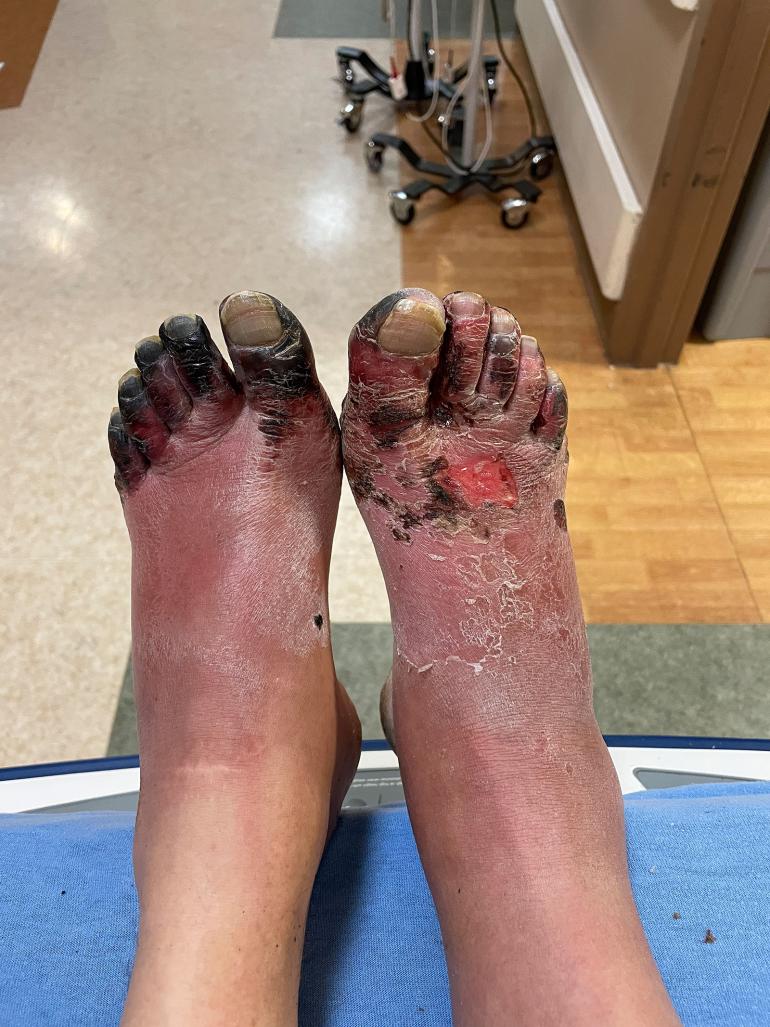 photo by Isla Freibee Frostbitten Feet