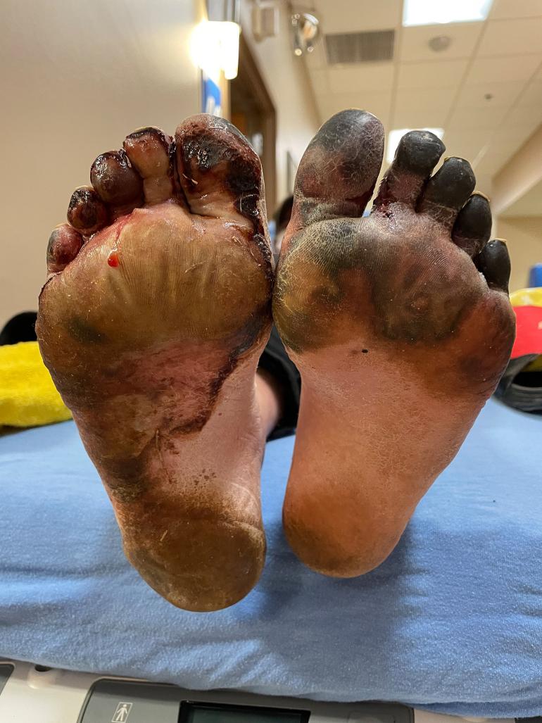 photo by Isla Freibee Frostbitten Feet