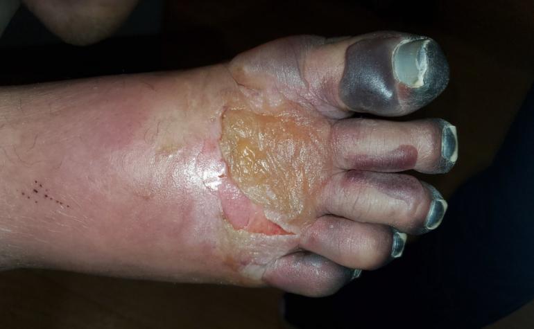 photo by Isla Freibee Frostbitten Feet