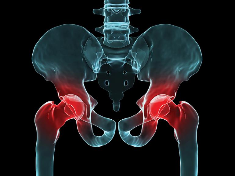 Graphic by Isla Friebe hip, orthopedic surgery, hip injuries